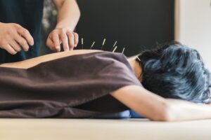 Acupuncture